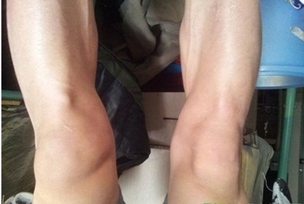 膝蓋骨質增生 (42) 