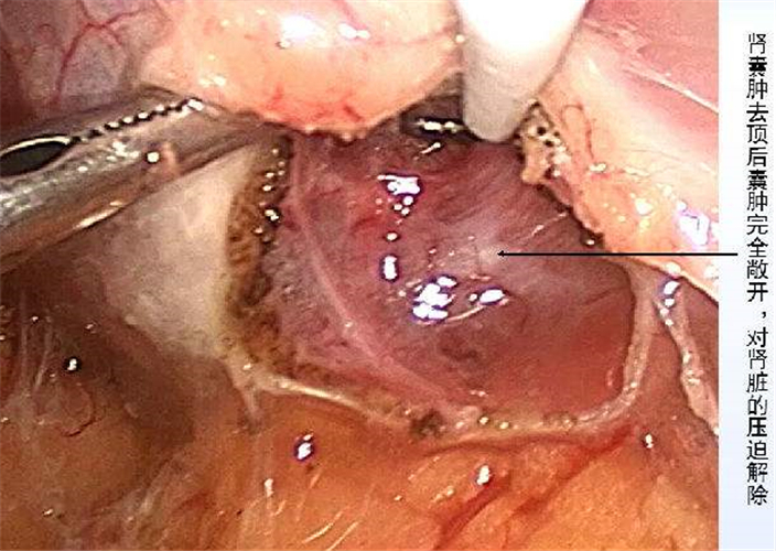 腎囊腫手術解說