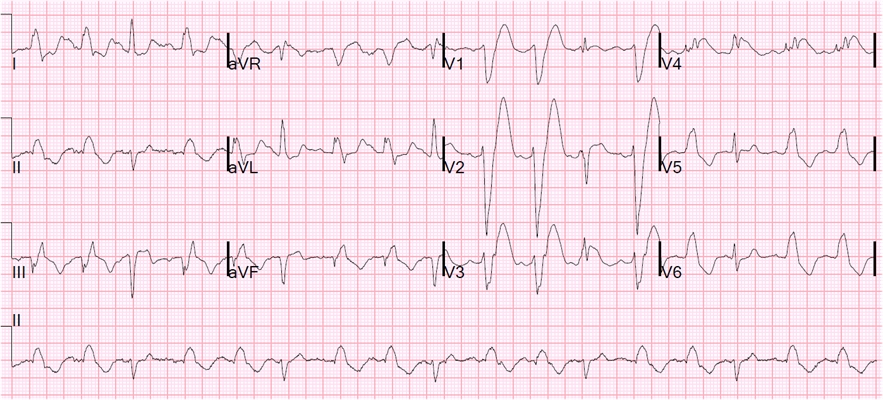高鉀血癥心電圖 (49) 
