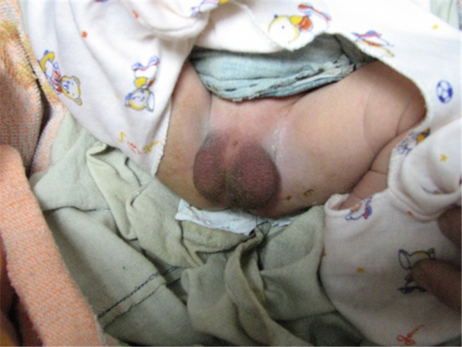 男嬰男性假兩性畸形