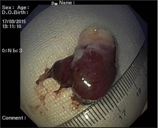 炎性胃息肉切除