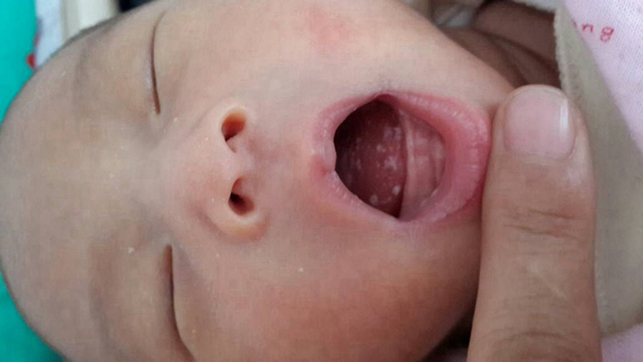 寶寶鵝口瘡 (67) 