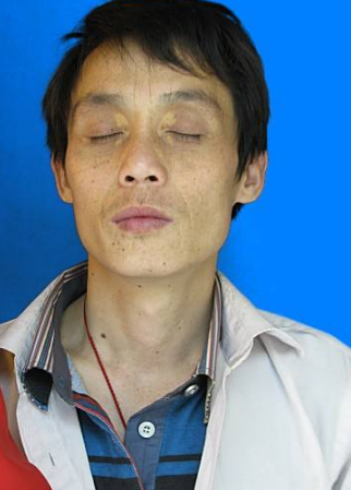 男人臉上長斑的