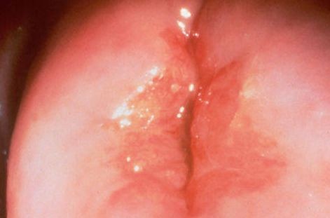 宮頸癌的早期症狀