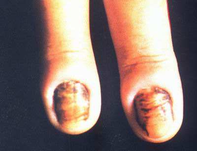 女性白色念珠菌感染途徑 