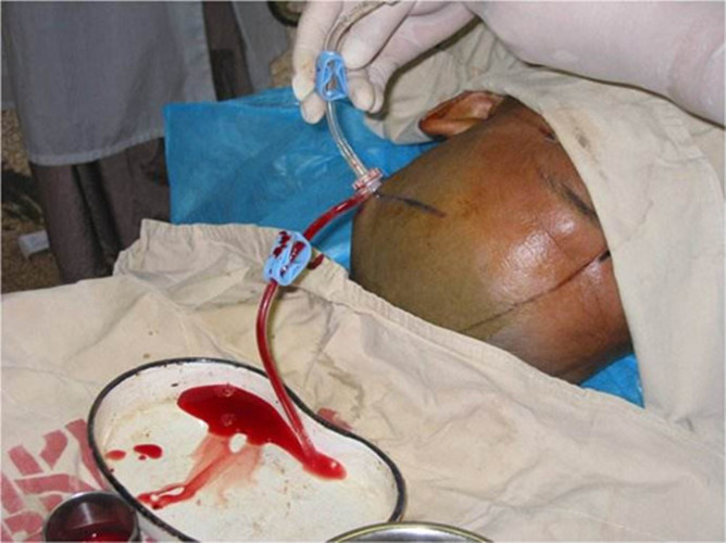 微創治療高血壓腦出血