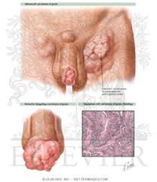 早期陰莖癌圖解症狀