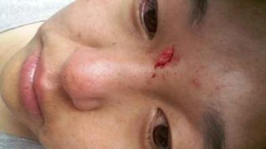 摔傷破傷風傷口