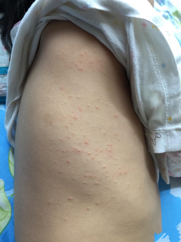 藥物性皮炎男子側背有大部分疙瘩