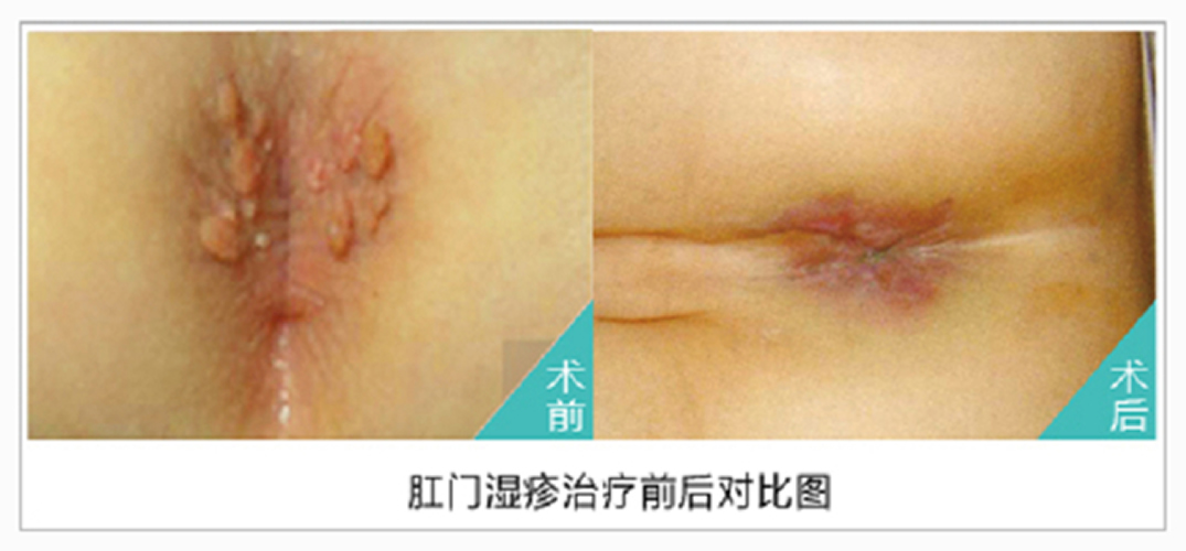肛周溼疹治療前後對比