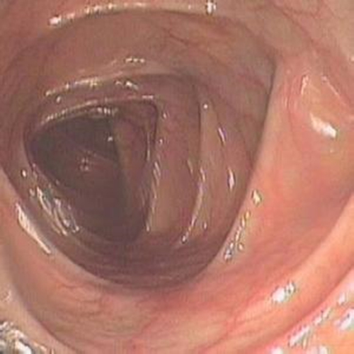 缺血性慢性結腸炎的