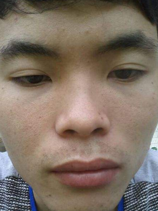 男人臉上長斑的