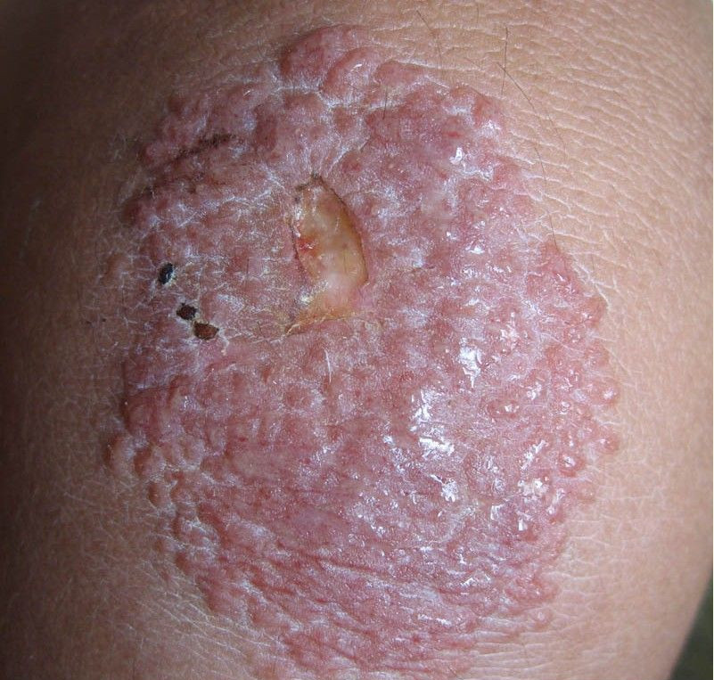 嚴重放射性皮炎