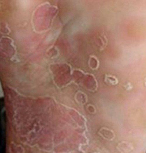 潰爛的妊娠合併梅毒