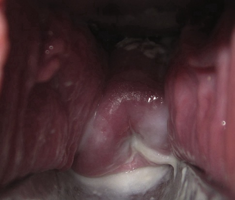 子宮肥大圖 (49) 