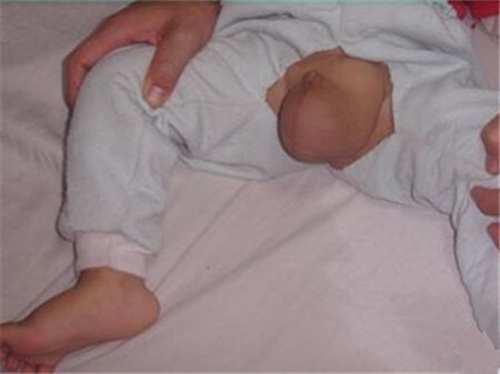 小兒鞘膜積液 (37) 