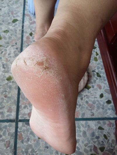 腳底乾裂 (6) 
