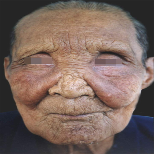 老人面部皮脂腺痣