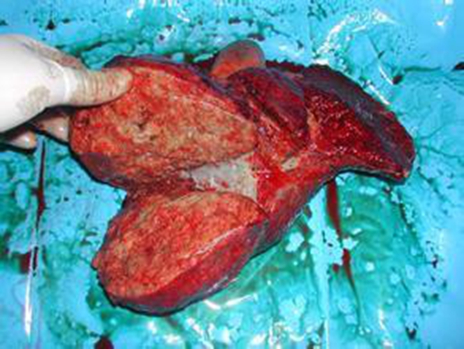 肝內膽管癌後期症狀