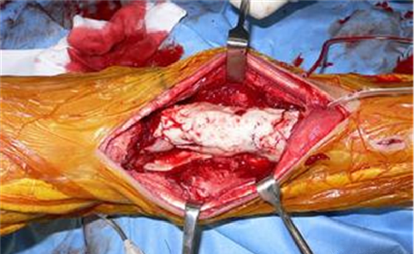 治療大腿骨腫瘤