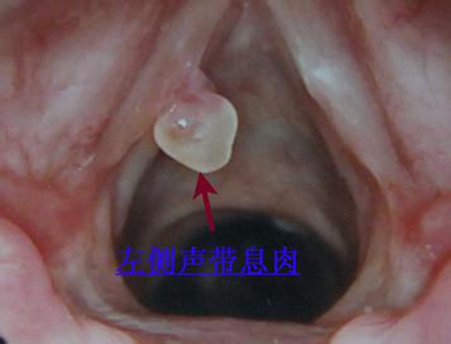 左聲帶息肉