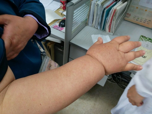 肢端肥大症  (9) 