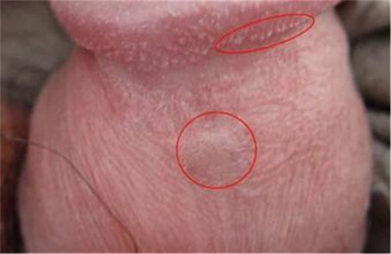 男肉芽狀假性溼疣男