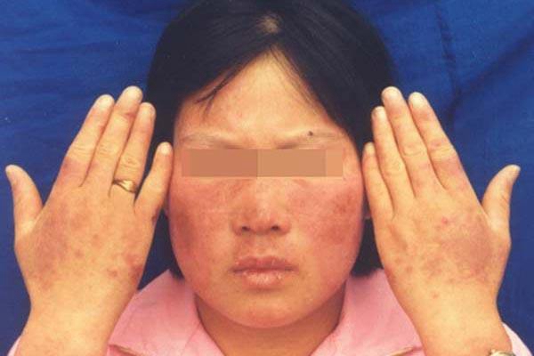 紅斑結節圖 (63) 