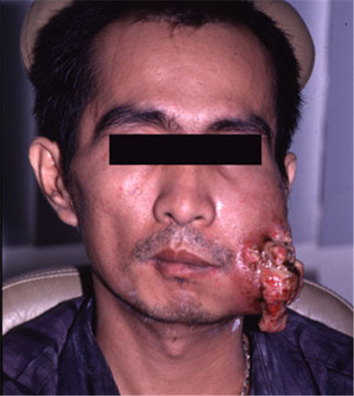 中年人頰癌症狀