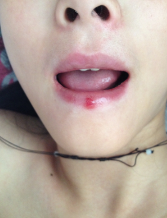 嘴唇潰瘍