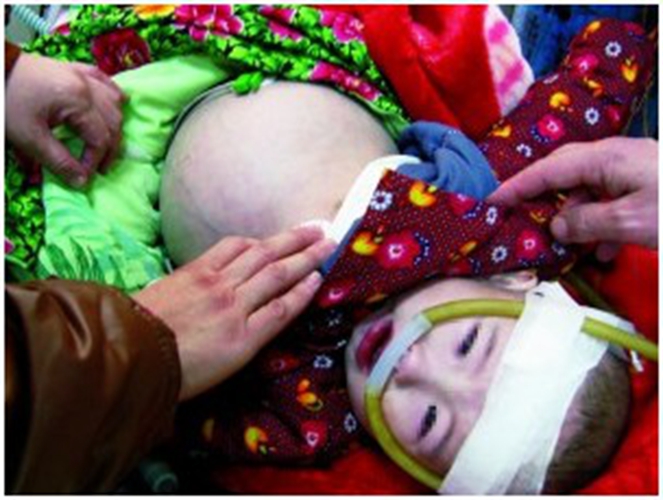 小孩腹水病人治療