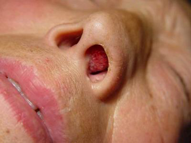 中老年婦女慢性鼻炎