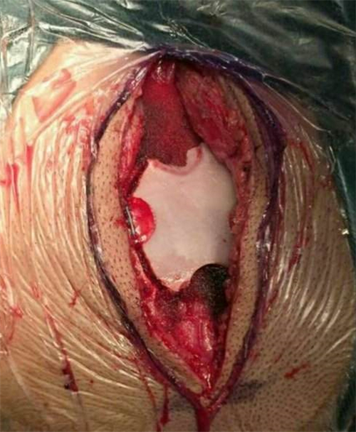 手術治療腦梗塞