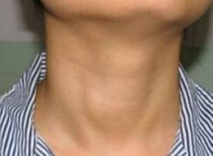 人體喉腫瘤症狀的