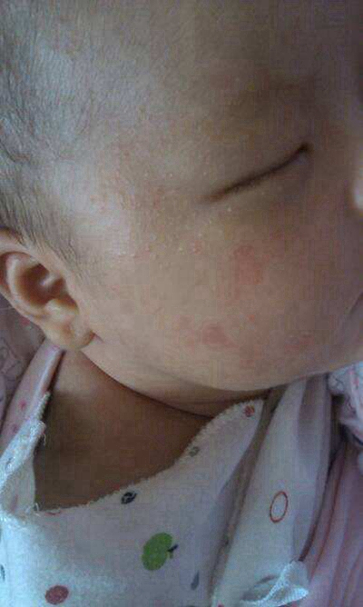 急性皮炎的症狀