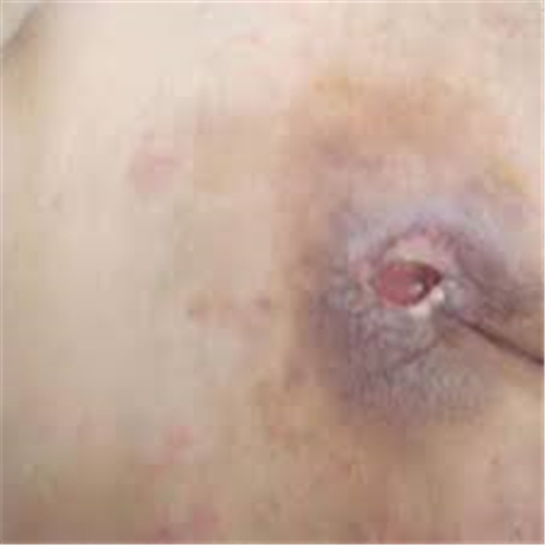 早期外陰瘙癢的症狀