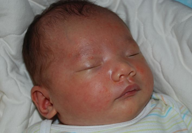 臉上皮膚過敏症狀