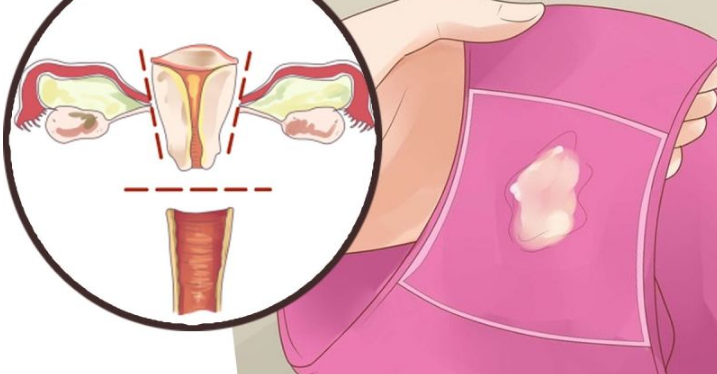 白帶帶有褐色分泌物 (58) 