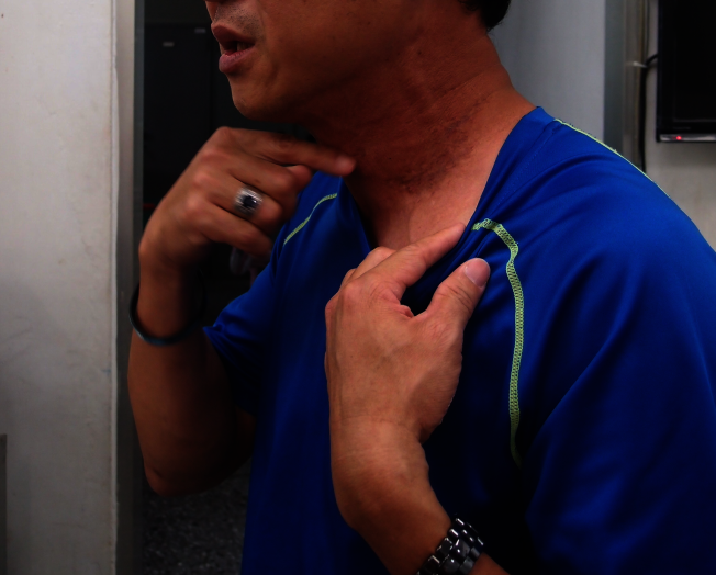 男性出現喉腫瘤的