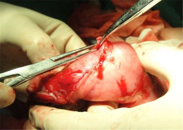 手術治療中的腸粘連