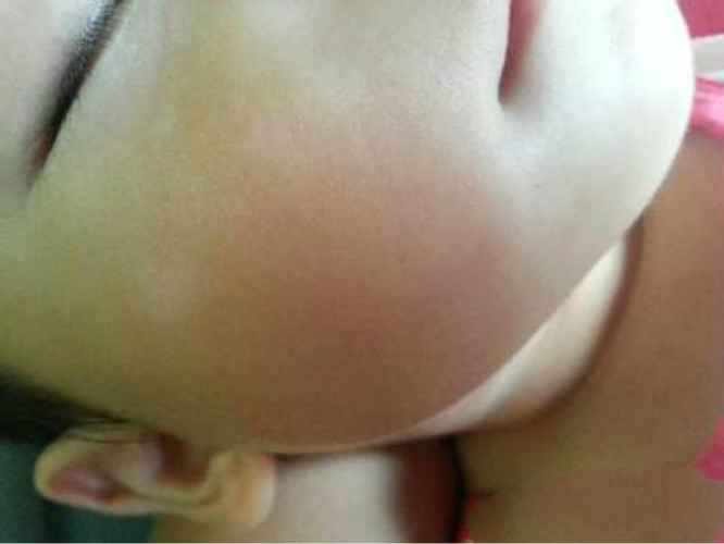 蛔蟲病臉部症狀 