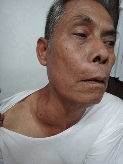 頜下淋巴結腫大