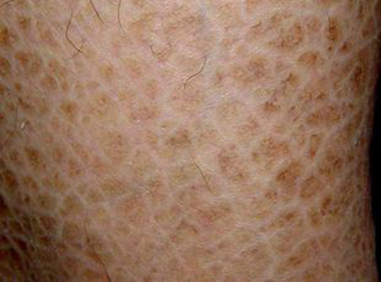 小腿皮膚像魚鱗 (56) 