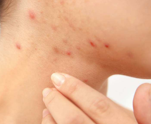 孕婦膽汁淤積症狀