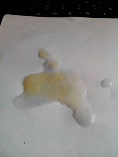 不正常精液液化