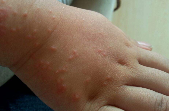 體內有寄生蟲的症狀 (56) 