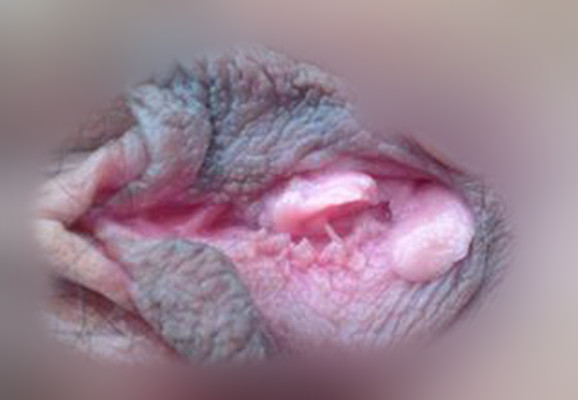 黴菌陰炎症狀 (43) 