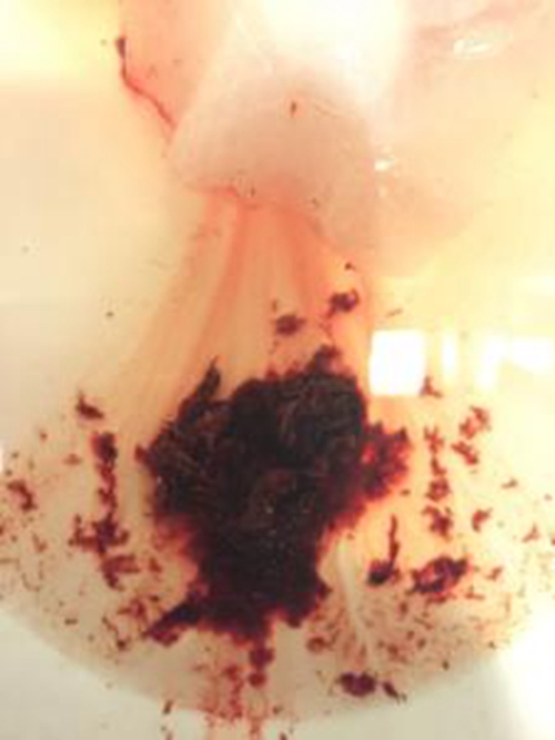 早孕藥流排出孕囊的實體的