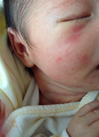 臉上皮膚過敏症狀