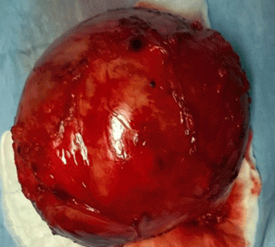 圓形腎上腺腫瘤